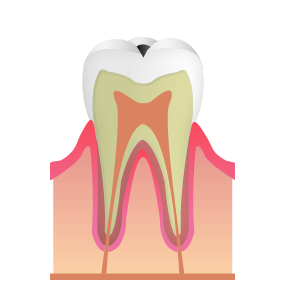 C1_むし歯治療