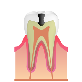 C2_むし歯治療