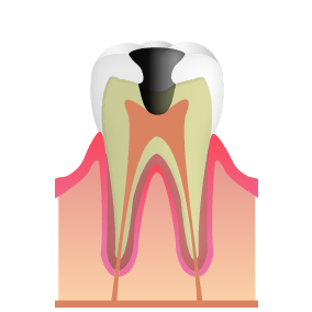 C3_むし歯治療