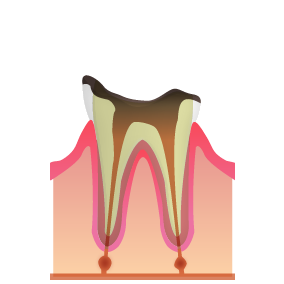 C4_むし歯治療