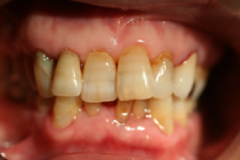 重度歯周病の治療例2_治療前