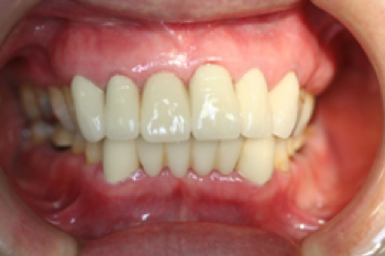 重度歯周病の治療例2_治療後