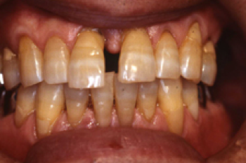 重度歯周病の治療例3_治療前