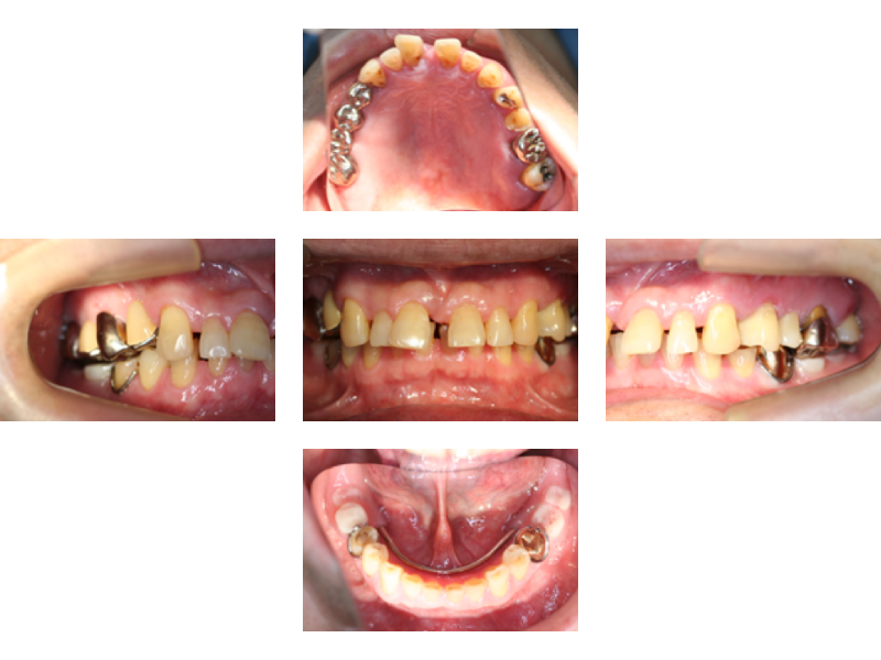 重度歯周病の治療例1_治療前