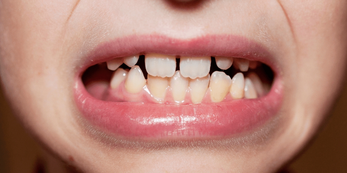 先天性欠如歯（永久歯が生えない/大人乳歯）について